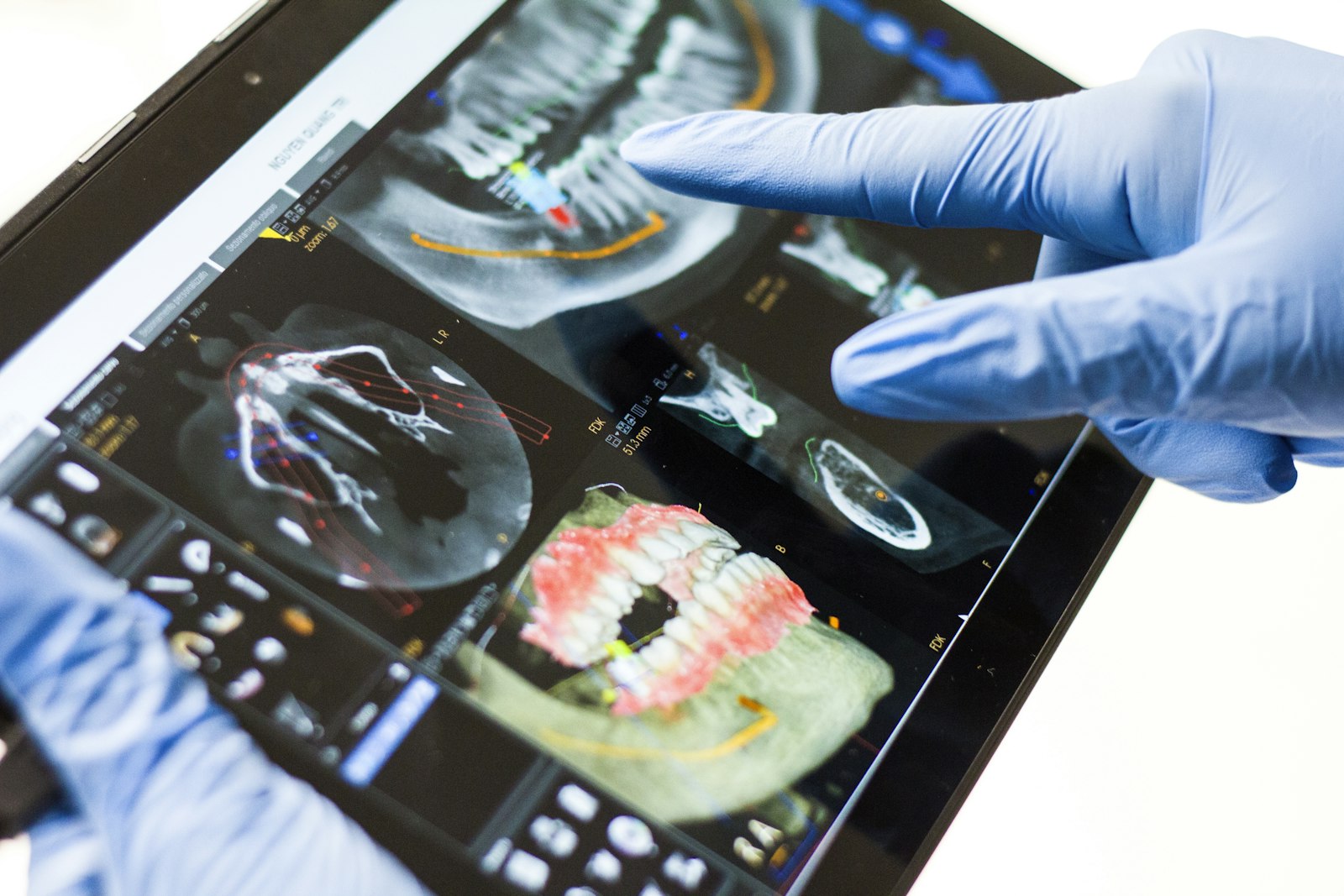 A digital intraoral scan on a monitor